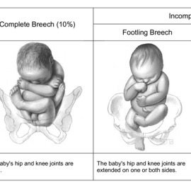 Breech Births: Why C-Section Delivery is Safer than Vaginal Delivery