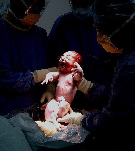 C-Section Awareness Month - Michigan Cerebral Palsy Attorneys