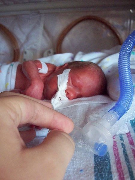 Premature Birth - Cerebral Palsy