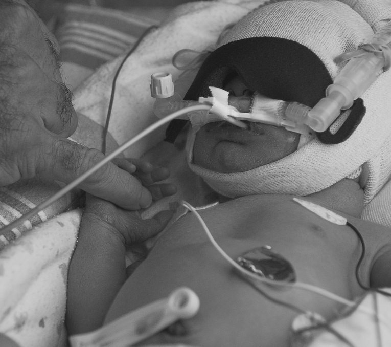 Hypoxic Ischemic Encephalopathy (HIE) and Seizures