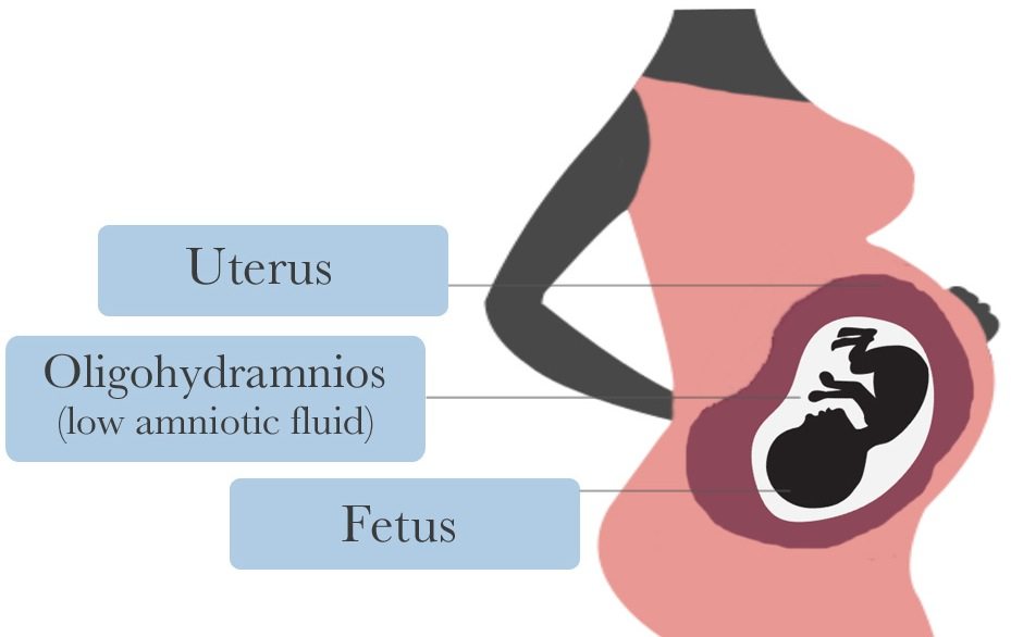 How Oligohydramnios Causes Cerebral Palsy (CP) | Michigan Cerebral Palsy Attorneys
